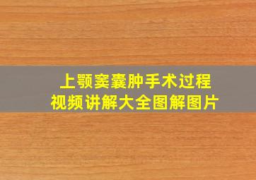 上颚窦囊肿手术过程视频讲解大全图解图片