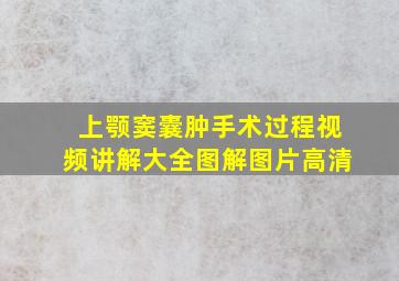 上颚窦囊肿手术过程视频讲解大全图解图片高清