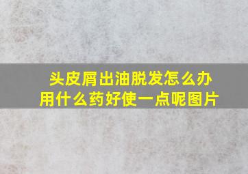 头皮屑出油脱发怎么办用什么药好使一点呢图片