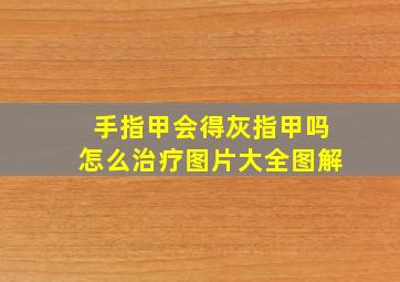 手指甲会得灰指甲吗怎么治疗图片大全图解