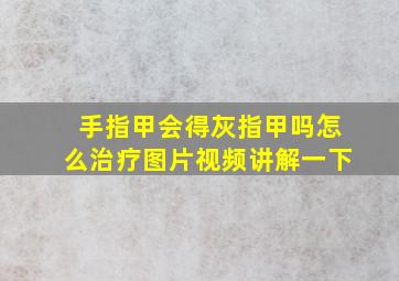 手指甲会得灰指甲吗怎么治疗图片视频讲解一下