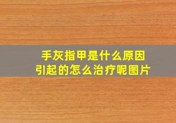 手灰指甲是什么原因引起的怎么治疗呢图片