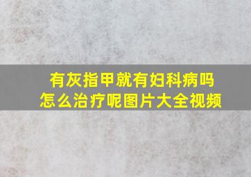 有灰指甲就有妇科病吗怎么治疗呢图片大全视频