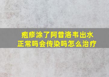 疱疹涂了阿昔洛韦出水正常吗会传染吗怎么治疗