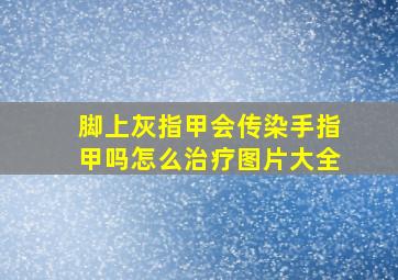 脚上灰指甲会传染手指甲吗怎么治疗图片大全