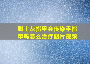 脚上灰指甲会传染手指甲吗怎么治疗图片视频