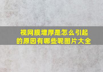 视网膜增厚是怎么引起的原因有哪些呢图片大全