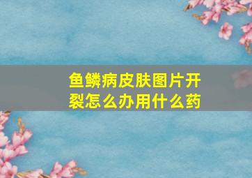 鱼鳞病皮肤图片开裂怎么办用什么药