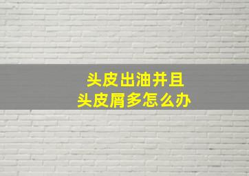 头皮出油并且头皮屑多怎么办