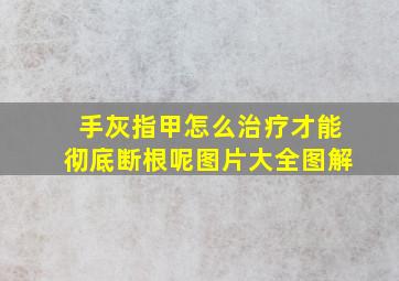 手灰指甲怎么治疗才能彻底断根呢图片大全图解