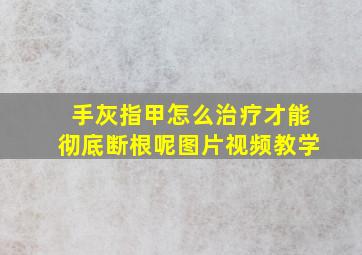 手灰指甲怎么治疗才能彻底断根呢图片视频教学