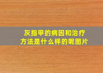 灰指甲的病因和治疗方法是什么样的呢图片