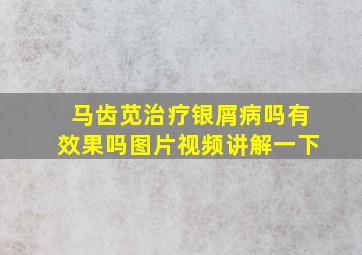 马齿苋治疗银屑病吗有效果吗图片视频讲解一下